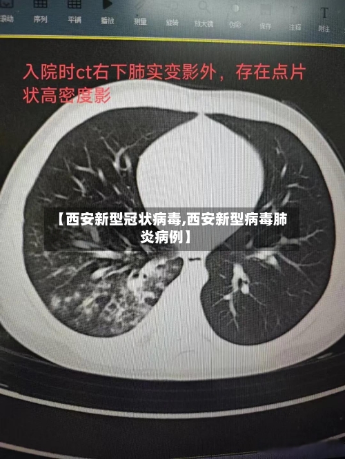 【西安新型冠状病毒,西安新型病毒肺炎病例】-第2张图片
