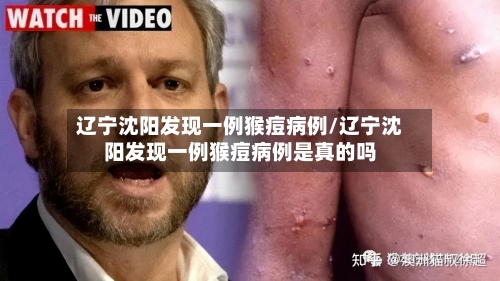 辽宁沈阳发现一例猴痘病例/辽宁沈阳发现一例猴痘病例是真的吗-第3张图片