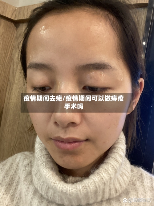 疫情期间去痣/疫情期间可以做痔疮手术吗-第2张图片