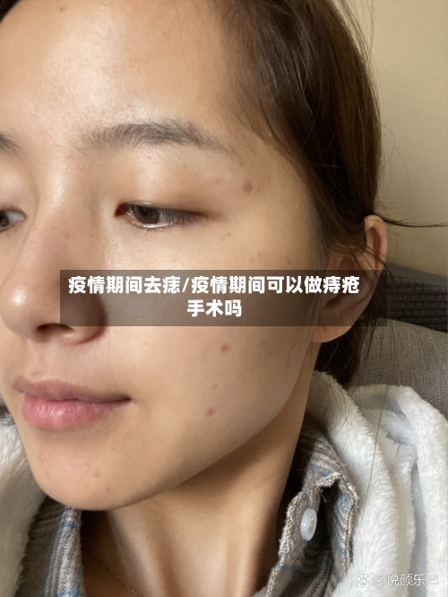 疫情期间去痣/疫情期间可以做痔疮手术吗
