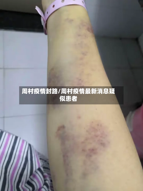 周村疫情封路/周村疫情最新消息疑似患者