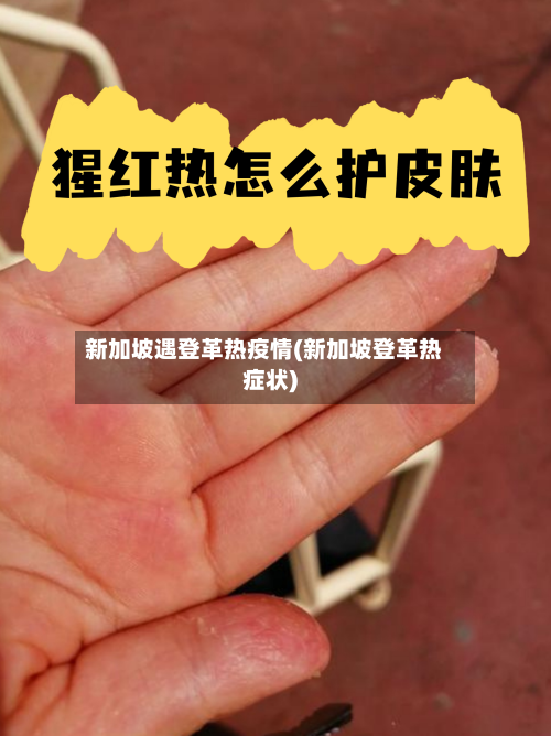 新加坡遇登革热疫情(新加坡登革热症状)